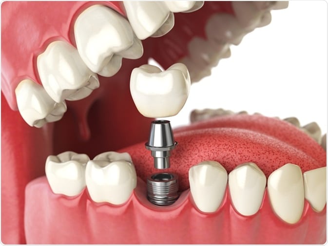 Dental implants in desoto tx