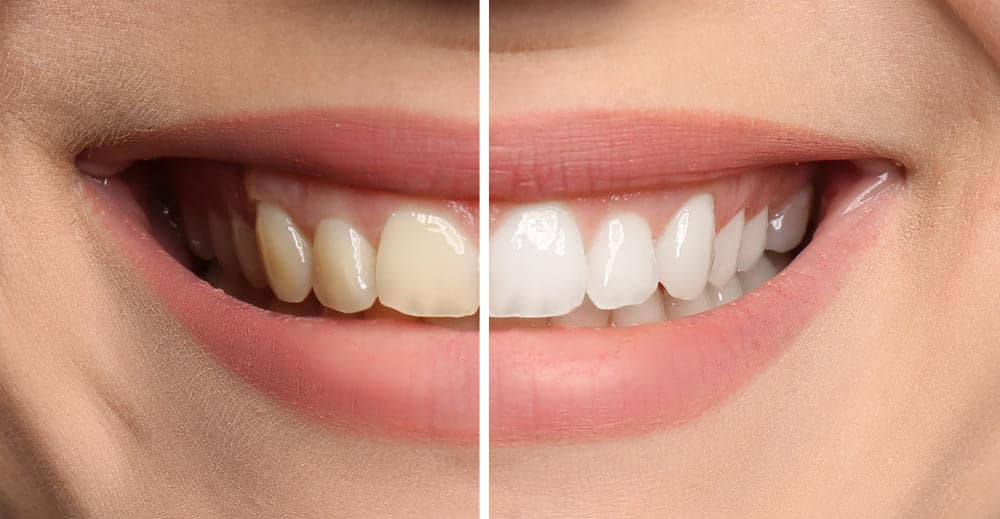 before and after teeth whitening in deSoto tx